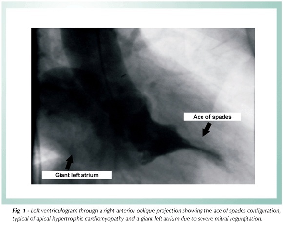 Apical hypertrophic cardiomyopathy with giant left atrium