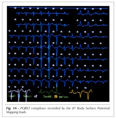 Ventricular electrical activation in cardiac resynchronization as characterized by body surface potential mapping
