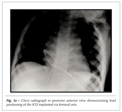 Incidence of shock and quality of life in young patients with implantable cardioverter-defibrillator