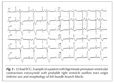 Radiofrequency catheter ablation of premature ventricular contractions originating in the right ventricular outflow tract