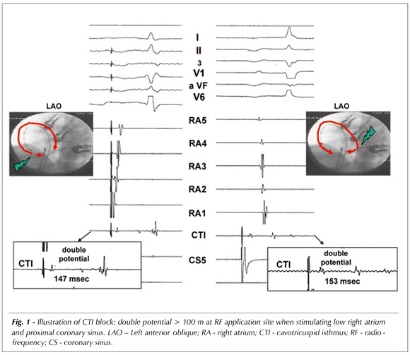 Ablation of typical atrial flutter: a prospective randomized study of cooled-tip versus 8-mm-tip catheters