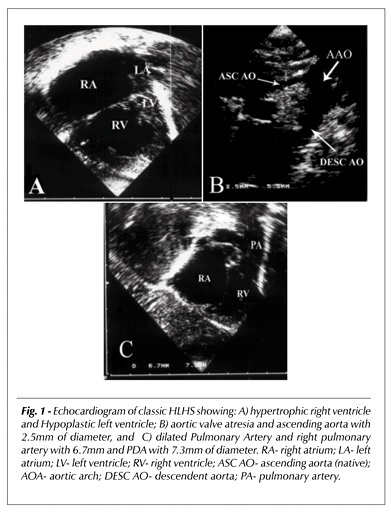 Hypoplastic left heart syndrome: the influence of surgical strategy on outcomes