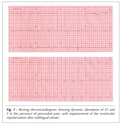 Percutaneous coronary intervention in single coronary artery in a patient with hig-risk unstable angina