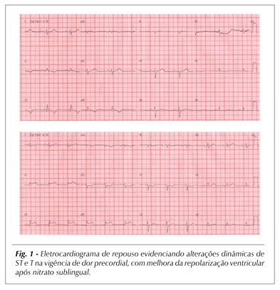 Intervenção coronariana percutânea em artéria coronariana única em paciente com angina instável de alto risco