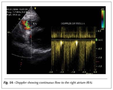 Traumatic fistula between the right coronary artery and right atrial chamber