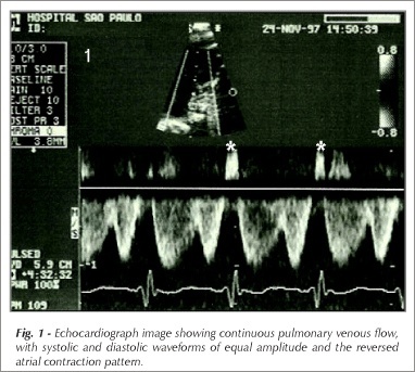 Echocardiograph pulmonary venous flow patterns in congenital heart defects with increased pulmonary flow
