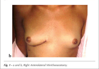 Correction of simple congenital heart defects in children and adolescents through minithoracotomies