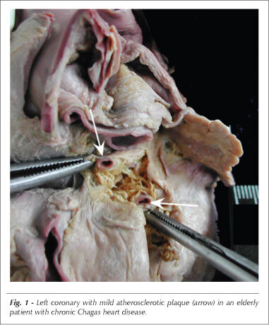 Macroscopic aspects of chronic Chagas heart disease in aging