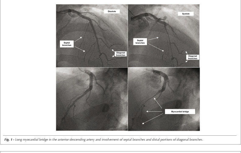 Multi-arterial myocardial bridge: uncommon clinical and anatomical presentations