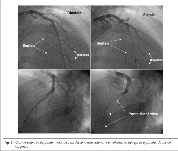 Ponte miocárdica multiarterial: apresentações clínica e anatômica incomuns