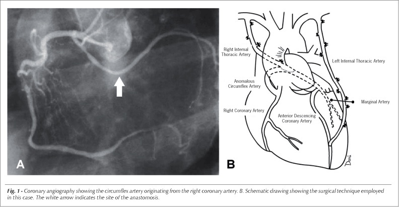 Coronary artery bypass surgery in patients with anomalous circumflex artery