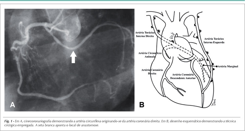 Cirurgia de revascularização miocárdica em pacientes com artéria circunflexa anômala