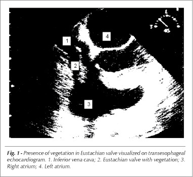 Eustachian valve endocarditis
