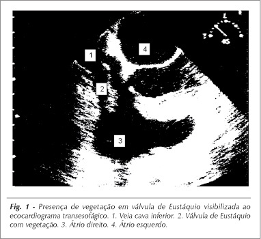 Endocardite em válvula de Eustáquio
