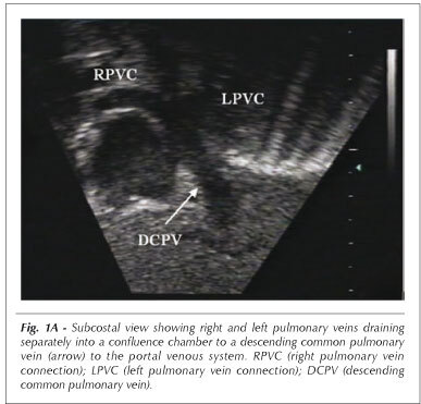 Infracardiac total anomalous pulmonary venous drainage: a diagnostic challenge