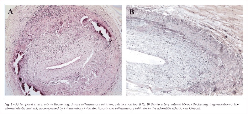Coronary giant cell arteritis and acute myocardial infarction