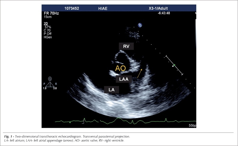 Left atrial appendage: real-time three-dimensional transthoracic echocardiographic image