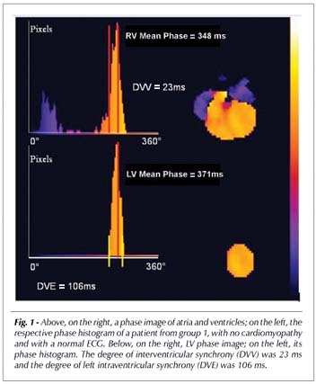 Ventricular synchrony in patients with dilated cardiomyopathy and normal individuals: assessment by radionuclide ventriculography