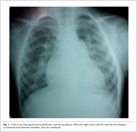 Case 2/2007: a two-year-old child with ventricular septal defect and right ventricular anomalous muscle bundle