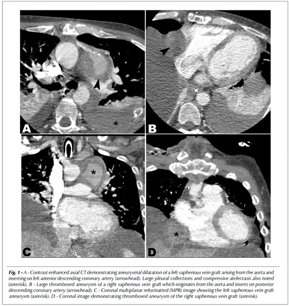 Multiple aneurysms of aortocoronary saphenous vein grafts with fatal rupture