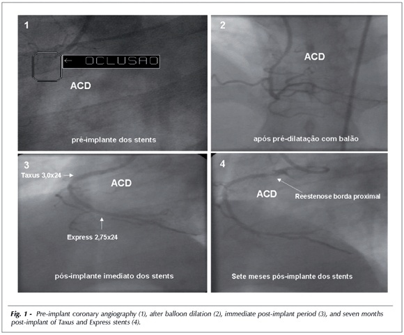 Late coronary thrombosis secondary to implantation of paclitaxel-eluting stent without restenosis of conventional stents