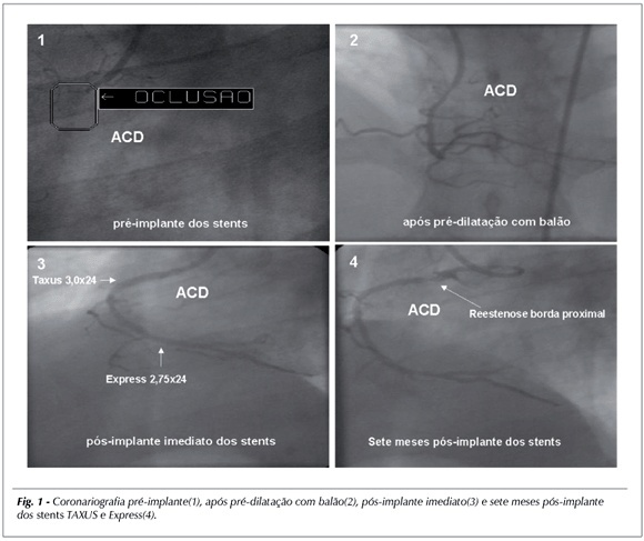 Trombose coronariana tardia secundária a implante de stent com paclitaxel sem reestenose dos stents convencionais