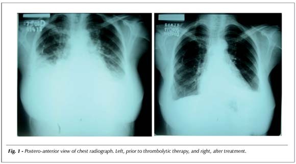 Acute thrombosis of mechanical mitral valve prosthesis successfully treated with thrombolysis