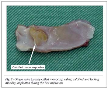 Annuloplasty of cryopreserved pulmonary homograft with Delrin stent in pulmonary atresia with ventricular septal defect