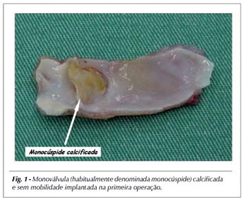 Anuloplastia de homoenxerto pulmonar criopreservado com anel de Delrin na atresia pulmonar com comunicação interventricular