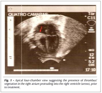 Combined rTPA and aspirin therapy for intracardiac thrombosis in neonates