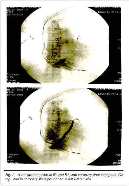 Ventricular resynchronization: comparing biventricular and bifocal right ventricular pacemakers