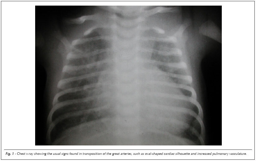 Case 3/2007: a three-month-old male infant with criss-cross heart, atrioventricular discordance, and double-outlet right ventricle, without pulmonary stenosis