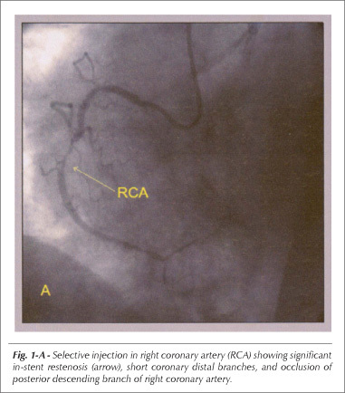 Pseudoaneurysm of left ventricle