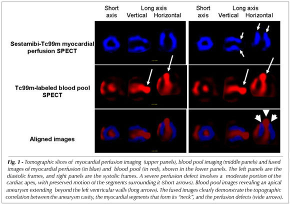 Characterization of the apical aneurysm of chronic chagas' heart disease by scintigraphic image co-registration