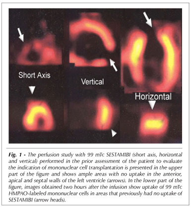 Labeled stem cells transplantation to the myocardium of a patient with chagas' disease