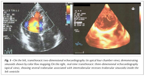 Poor left ventricle compaction: diagnosis optimized by real-time three-dimensional echocardiography