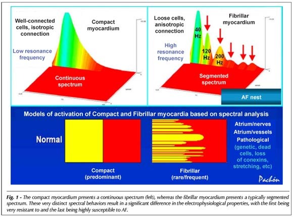 Radiofrequency catheter ablation of atrial fibrillation guided by spectral mapping of atrial fibrillation nests in sinus rhythm