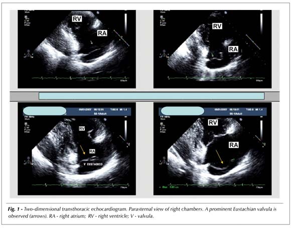 Eustachian valvula: real-time three-dimensional transthoracic echocardiographic imaging