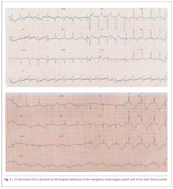 Transient left ventricular dysfunction due to stress-induced cardiomyopathy