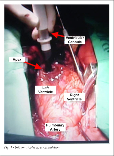 Use of mechanical circulatory support in cases of end-stage acute heart failure