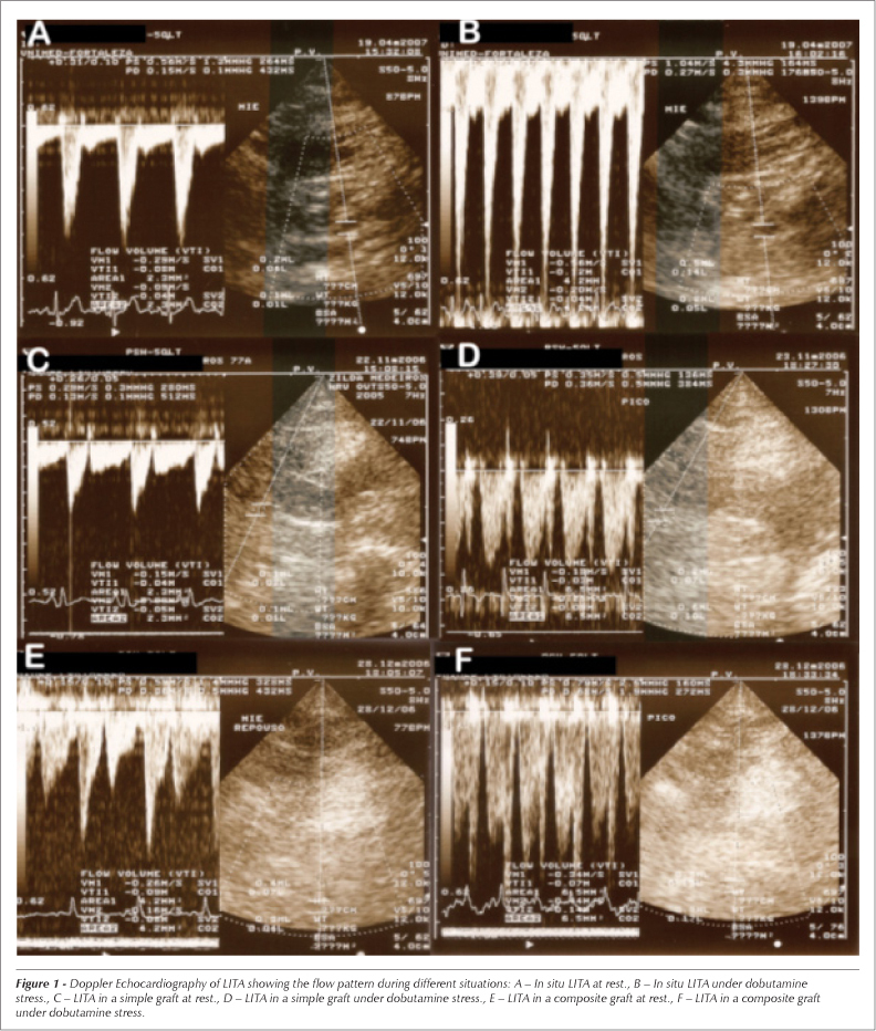 Doppler echocardiographic flow pattern of the left internal thoracic artery following myocardial revascularization using a composite graft