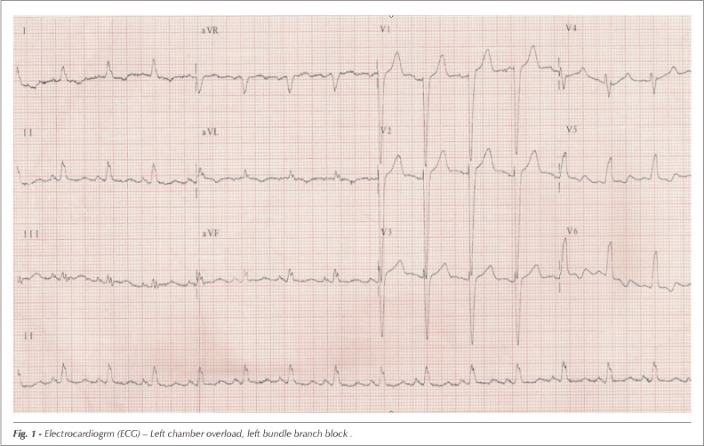 Caso 6/2007: early post-operative cardiogenic shock after stenting of thoracic aorta aneurysm
