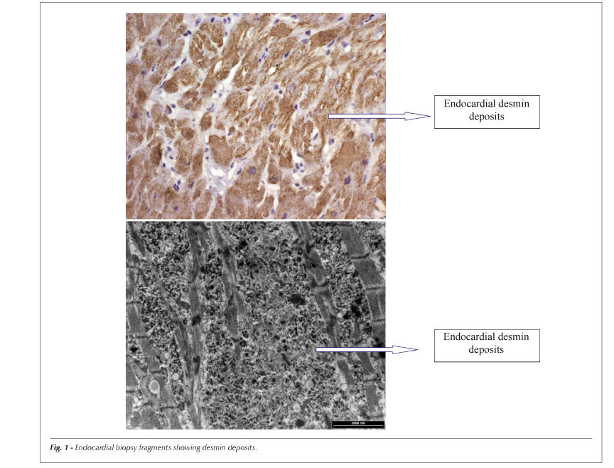 Desmin-related restrictive cardiomyopathy