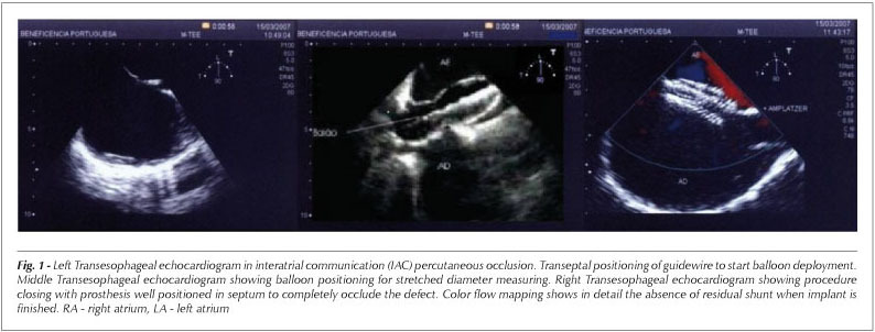 The relevance of real-time intraoperatory echocardiogram as a guide to percutaneous treatment of septal defects through Amplatzer device