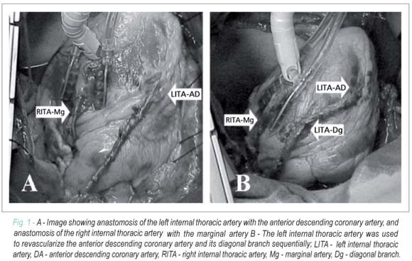 Surgical myocardial revascularization: off-pump use of bilateral internal thoracic artery grafting
