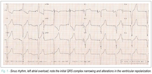 Case 01/2008: a young female patient with the familial form of hypertrophic cardiomyopathy, who evolved with syncope, complex ventricular arrhythmia and cardiogenic shock