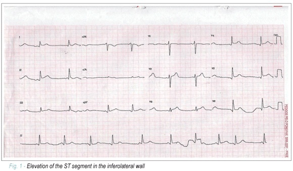 Broken-heart syndrome (Takotsubo syndrome)