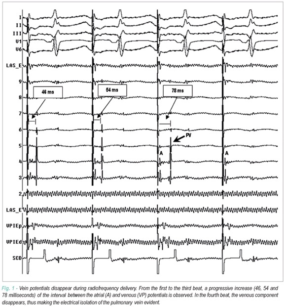 Radiofrequency ablation of paroxysmal atrial fibrillation: factors determining long-term clinical efficacy