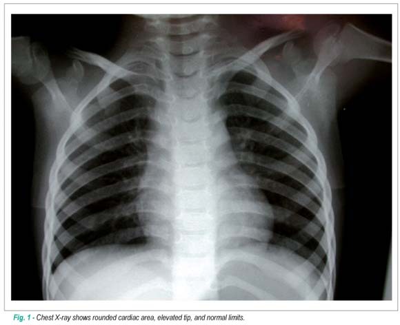 Case 1/2008: Three year old female patient with subvalvular, valvular, and supravalvular pulmonary stenosis