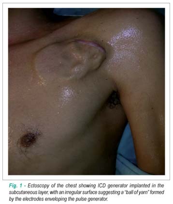 Twiddler syndrome